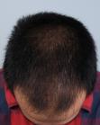 Before Hair Transplant&nbsp;Front